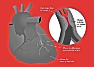 Demuestran tres veces más riesgo de infarto en los vacunados